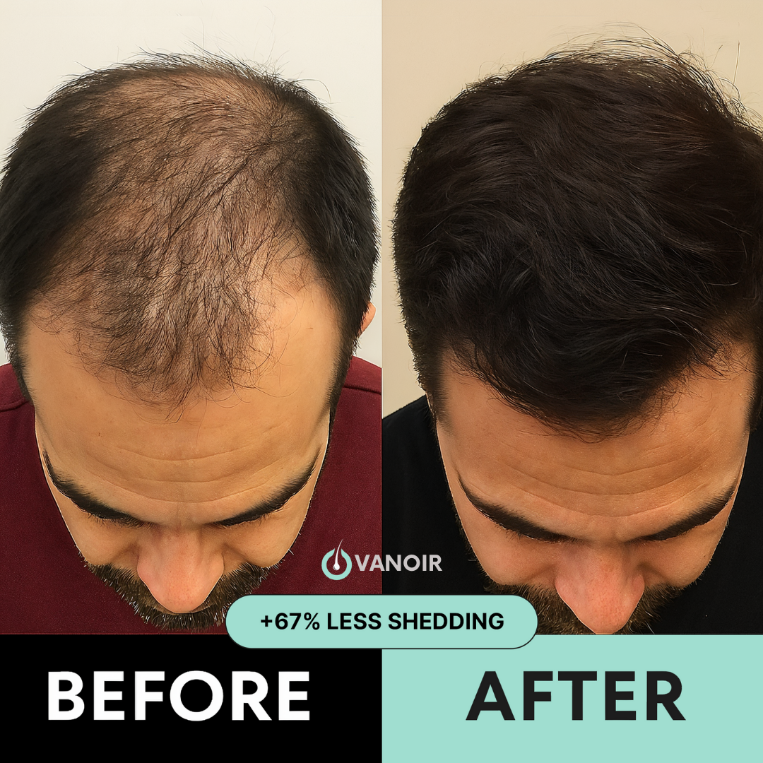 Hair Regrowth Micro-Infusion System
