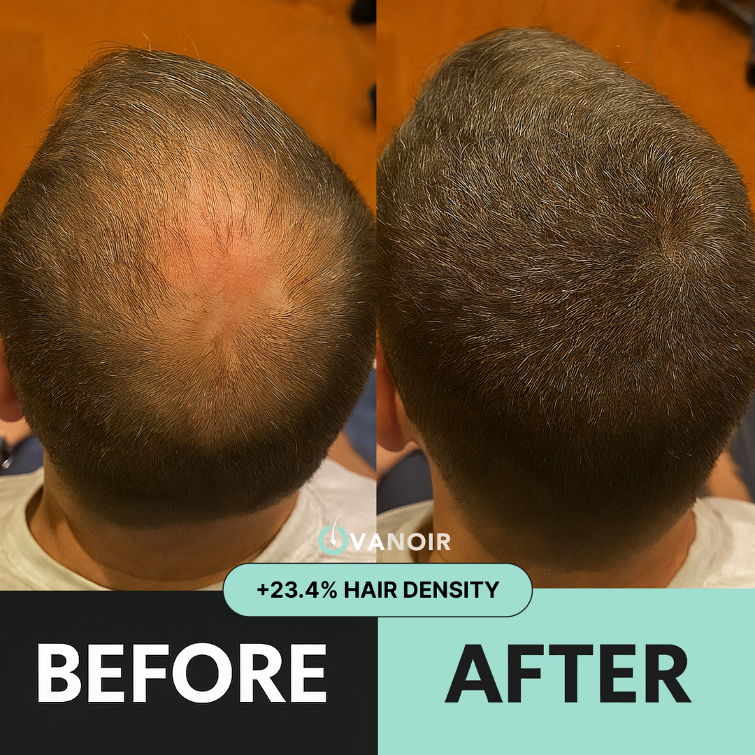Hair Regrowth Micro-Infusion Protocol