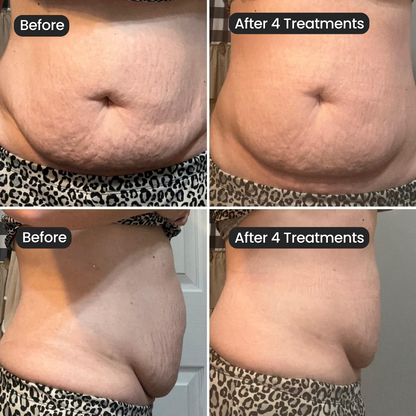 Vanoir Stretch Mark System