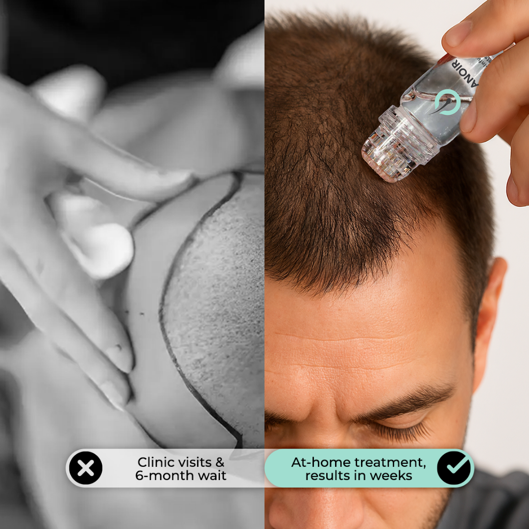 Hair Regrowth Micro-Infusion System