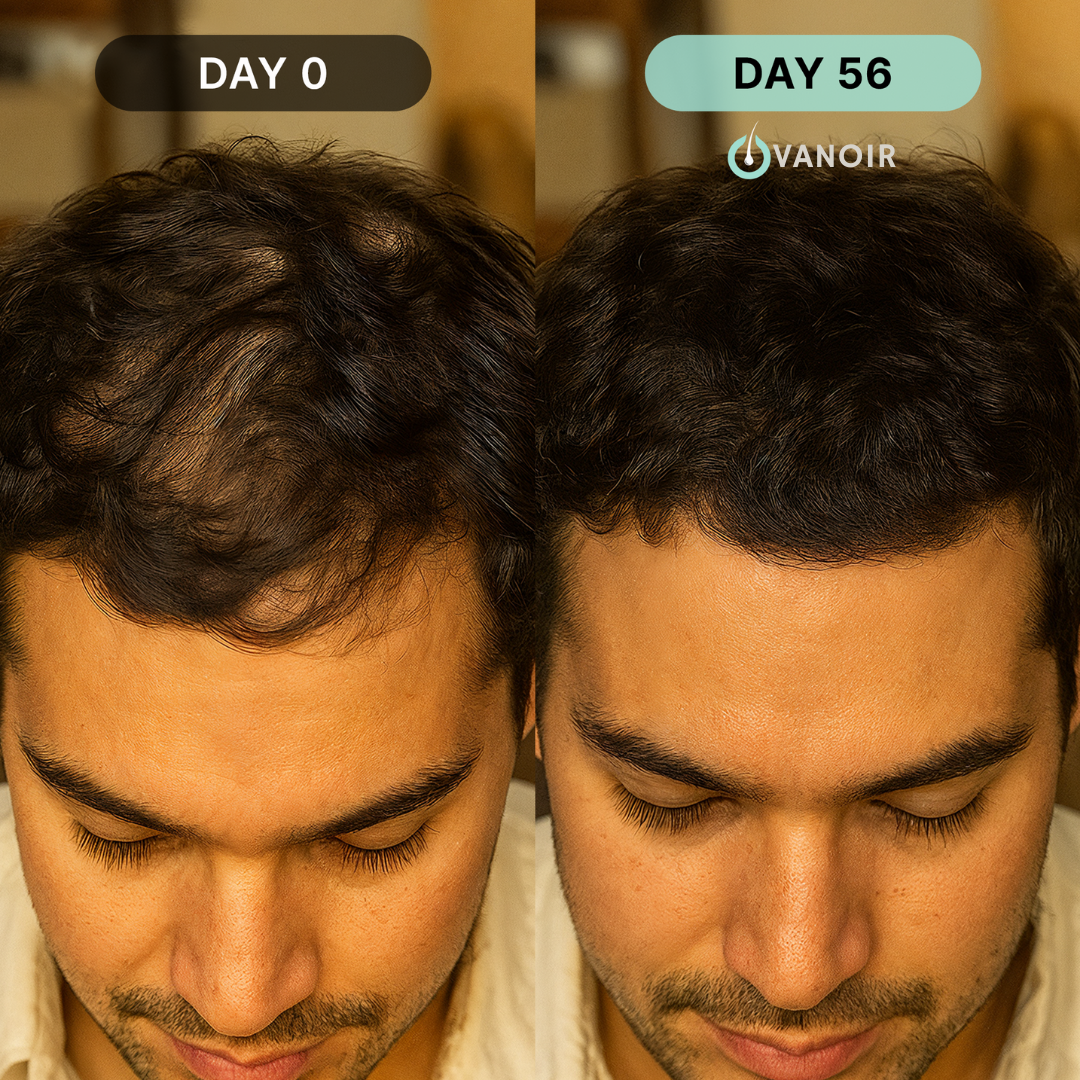 Hair Regrowth Micro-Infusion Protocol