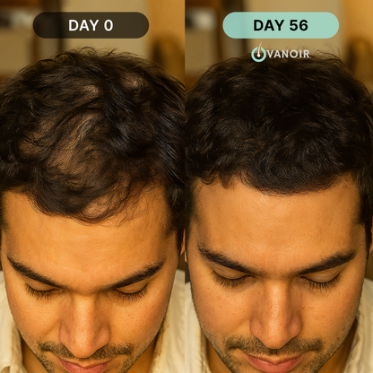 Hair Regrowth Micro-Infusion Protocol