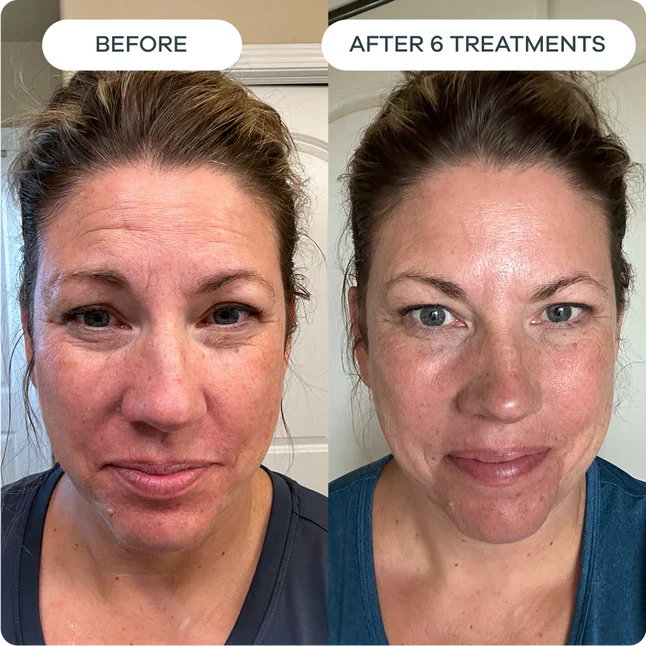 Fine Lines & Wrinkles